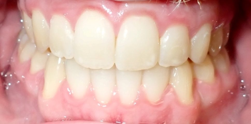 Vivid Smiles patient case 9 before and after treatment comparison after